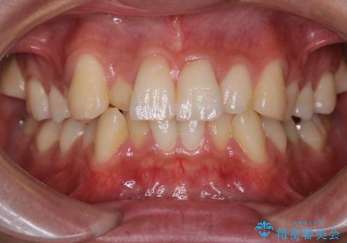 【インビザライン】マウスピース矯正希望。の治療前