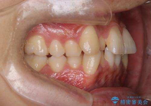 【インビザライン】マウスピース矯正希望。の治療前