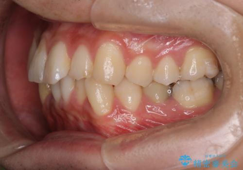 【インビザライン】マウスピース矯正希望。の治療前