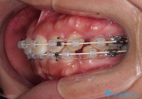 急速拡大とワイヤー抜歯矯正で唇を閉じやすくの治療中
