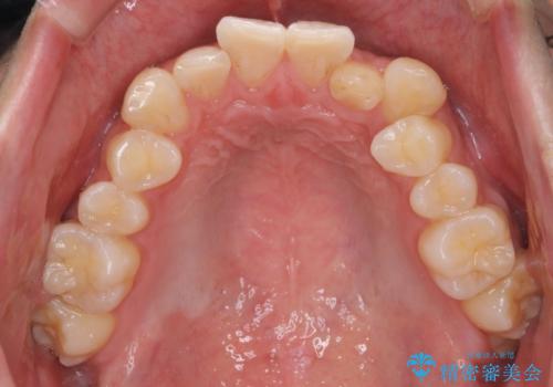 【インビザライン】マウスピース矯正希望。の治療前