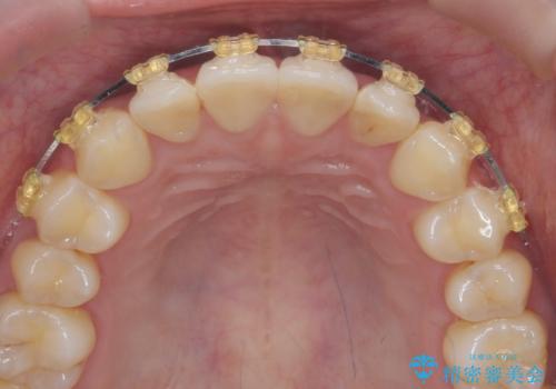 ワイヤー部分矯正治療を併用したマウスピース矯正治療の治療中