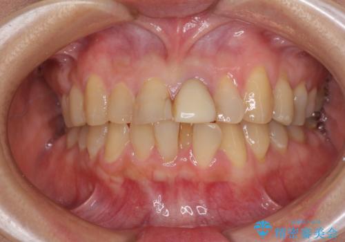 前歯のデコボコをワイヤー矯正できれいに整えるの症例 治療前