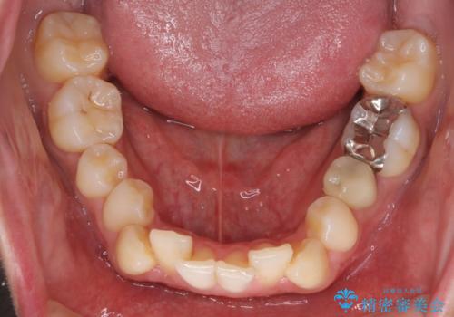 【インビザライン】マウスピース矯正希望。の治療前