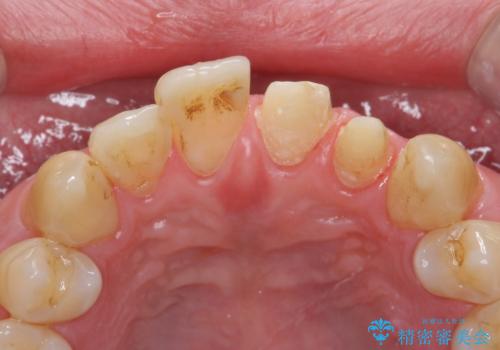 出っ歯を部分矯正で目立たなくする　セラミック治療もの治療中