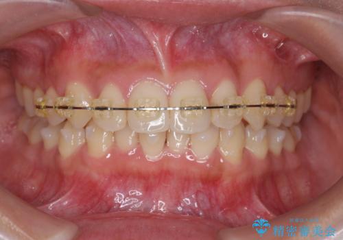 ワイヤー部分矯正治療を併用したマウスピース矯正治療の治療中
