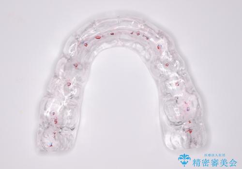 夜中の歯ぎしり ナイトガードで予防の治療中