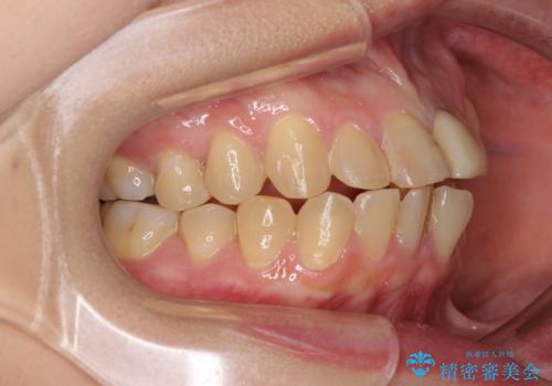 前歯のデコボコをワイヤー矯正できれいに整えるの治療前