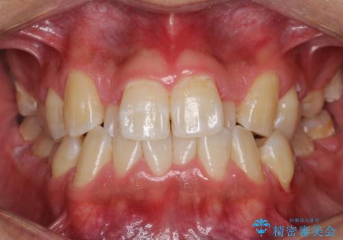 マウスピース矯正で素敵な笑顔に変身!前歯のガタツキを治しましたの治療前