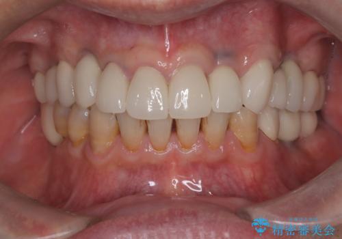 【オールセラミッククラウン・ファイバーコア】被せ物が揺れているの治療後