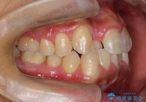 マウスピース矯正で素敵な笑顔に変身!前歯のガタツキを治しましたの治療前