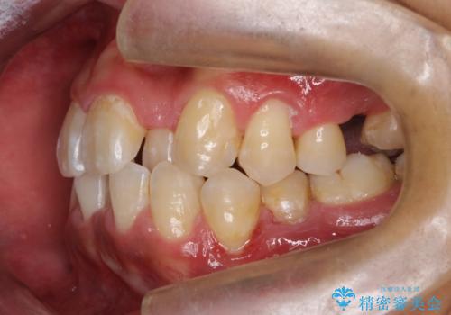 マウスピース矯正で素敵な笑顔に変身!前歯のガタツキを治しましたの治療前