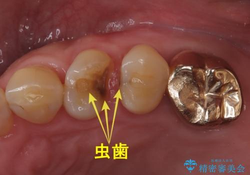 【ゴールドインレー PGA】フロスをしたら銀歯が取れたの症例 治療前