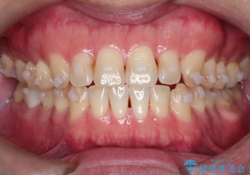 マウスピース矯正で自然な笑顔を実現! 前歯の咬み合わせを治しました。の治療中