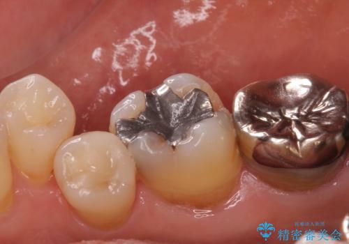 歯がかけた セラミックインレーでの治療の治療前