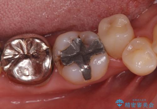 歯がかけた セラミックインレーでの治療