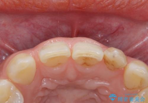 変色した前歯をキレイにしたい ジルコニアクラウンでの修復の治療前