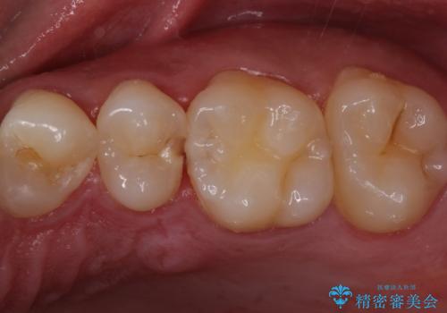 歯と歯の間の虫歯　セラミックインレーでの治療の症例 治療前