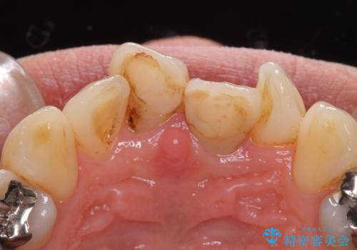 前歯をキレイにしたい ジルコニアクラウンでの治療の治療前