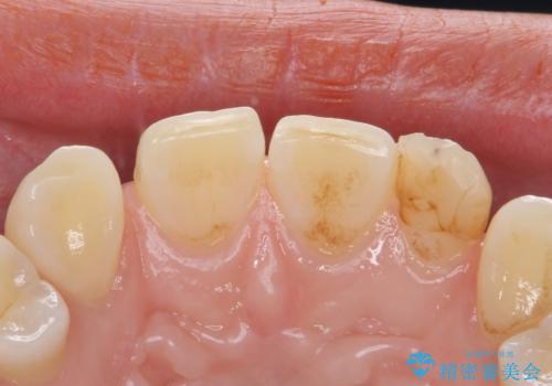 変色した前歯をキレイにしたい ジルコニアクラウンでの修復の治療前