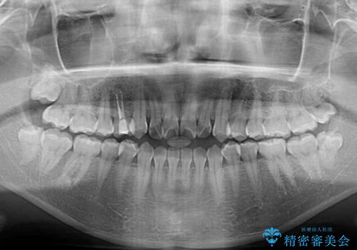 舌突出癖による開咬 舌のトレーニングを行いながら前歯の隙間を改善の治療前