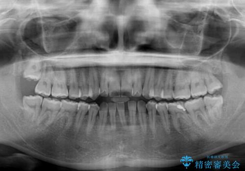 開咬と歯の欠損 ワイヤー装置を併用したインビザライン矯正治療の治療前
