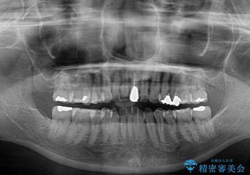 前歯のデコボコをワイヤー矯正できれいに整えるの治療前