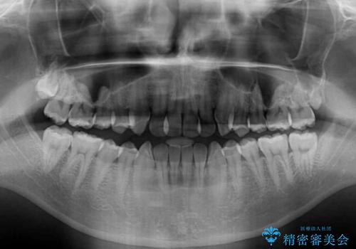 ワイヤー矯正を併用したインビザライン矯正治療の治療前