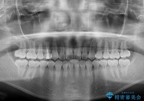 舌突出癖による開咬 舌のトレーニングを行いながら前歯の隙間を改善の治療後