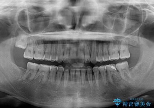 開咬と歯の欠損 ワイヤー装置を併用したインビザライン矯正治療の治療後