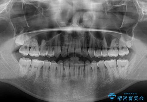 ワイヤー矯正を併用したインビザライン矯正治療の治療後