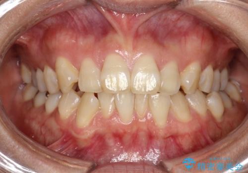 インビザラインによる矯正治療(非抜歯)　前歯の突出と上下の歯並びのガタつきの改善の治療前