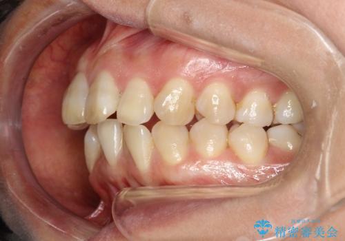 インビザラインによる矯正治療(非抜歯)　前歯の突出と上下の歯並びのガタつきの改善の治療前