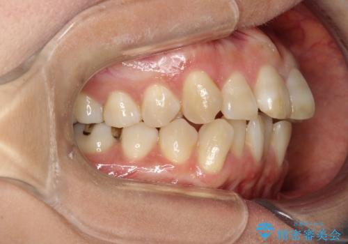 インビザラインによる矯正治療(非抜歯) 前歯の突出と上下の歯並びのガタつきの改善