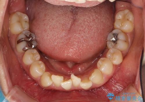インビザラインによる矯正治療(非抜歯) 前歯の突出と上下の歯並びのガタつきの改善の治療前