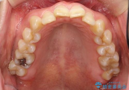 インビザラインによる矯正治療(非抜歯) 前歯の突出と上下の歯並びのガタつきの改善の治療前