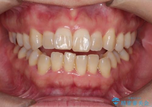 インビザラインによる矯正治療(非抜歯)　上下前歯の開き(開咬)と上下のガタつき(叢生)の改善の症例 治療前