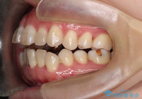 インビザラインによる矯正治療(非抜歯)　上下前歯の開き(開咬)と上下のガタつき(叢生)の改善の治療前