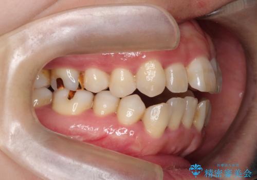 インビザラインによる矯正治療(非抜歯) 上下前歯の開き(開咬)と上下のガタつき(叢生)の改善の治療前