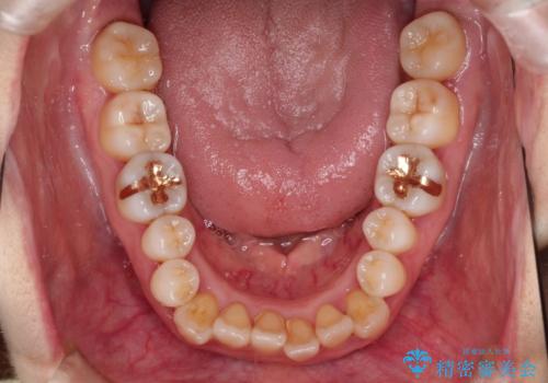 インビザラインによる矯正治療(非抜歯) 上下前歯の開き(開咬)と上下のガタつき(叢生)の改善の治療前