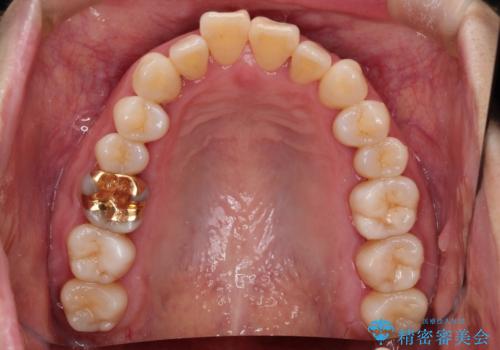 インビザラインによる矯正治療(非抜歯)　上下前歯の開き(開咬)と上下のガタつき(叢生)の改善の治療前