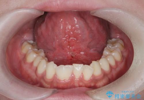 滑舌の改善　舌小帯の形成術の治療後