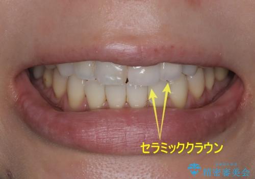 【オールセラミッククラウン】前歯の色が気になる!　左右で歯の長さが違う