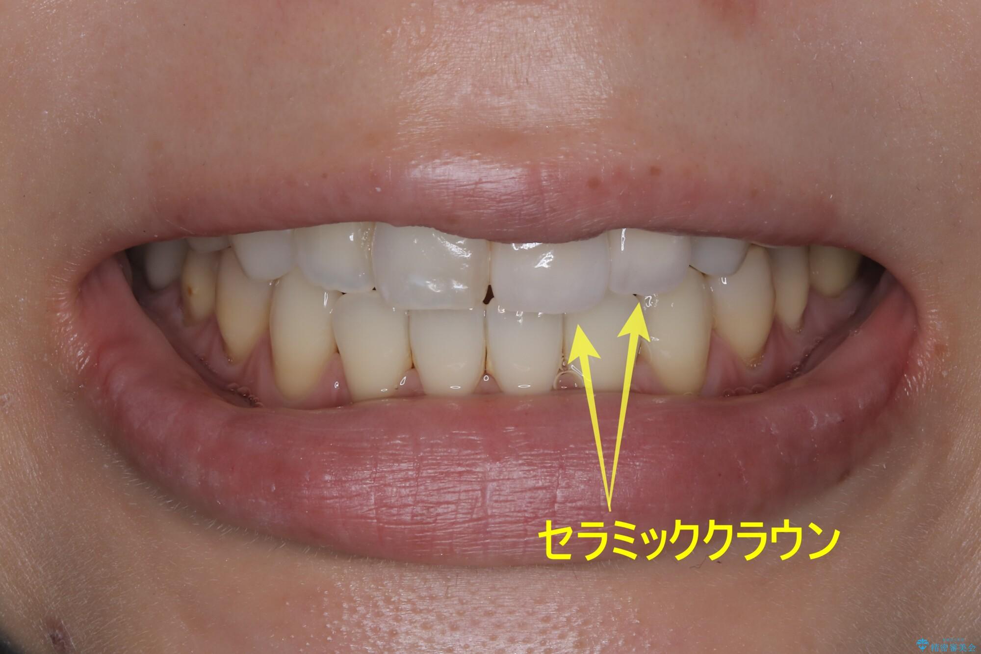 オールセラミッククラウン】前歯の色が気になる! 左右で歯の長さが違う