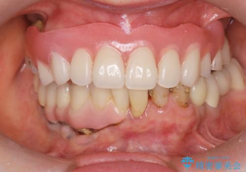 審美性に優れるノンクラスプデンチャー(バネの目立たない入れ歯)の症例 治療後