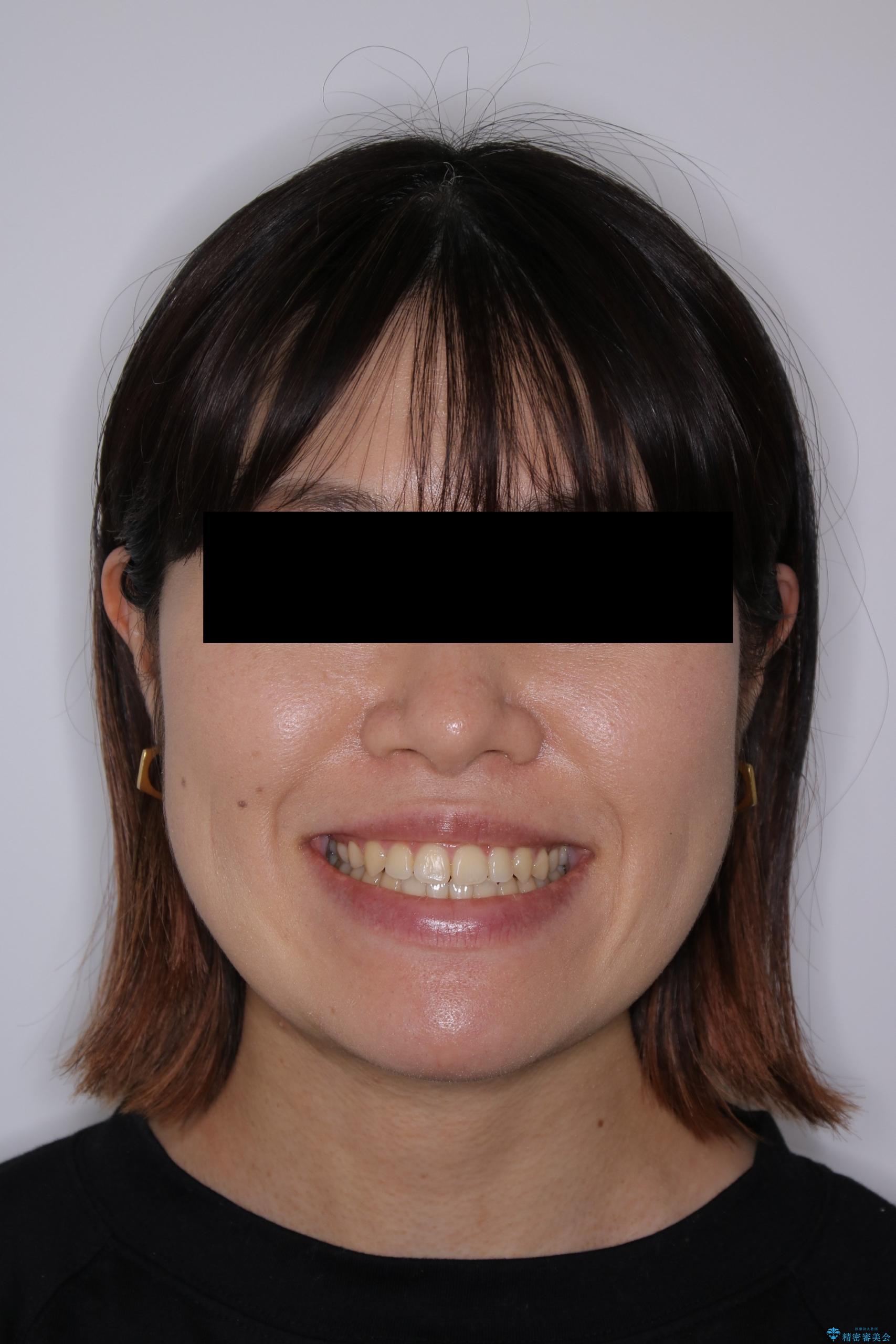歯茎が薄い方へのインビザライン治療、歯肉退縮予防の治療後（顔貌）