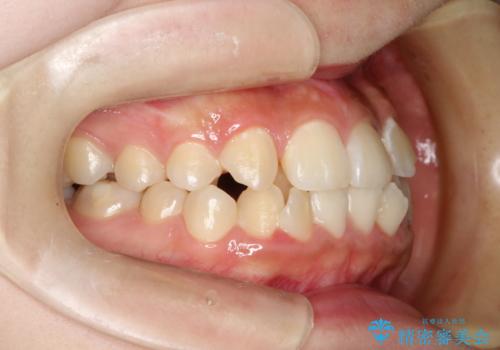 【ハーフリンガル】重度の叢生の治療前