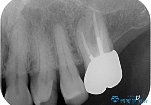 【ゴールドインレー PGA】フロスをしたら銀歯が取れたの治療前