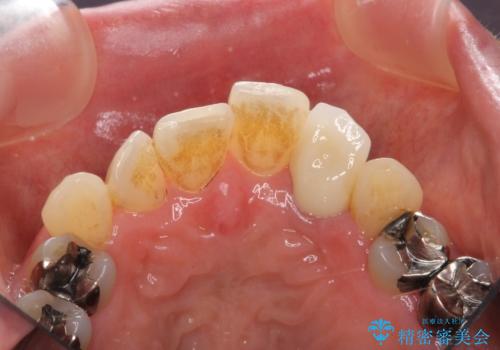 前歯の審美障害　セラミック治療の治療後