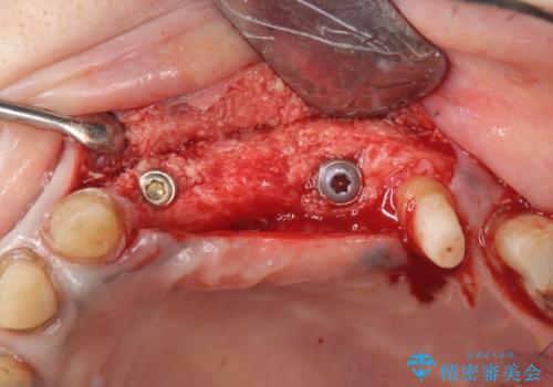 骨造成を行ったインプラント治療の治療中